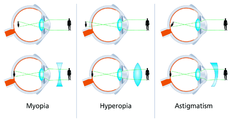 refractive error